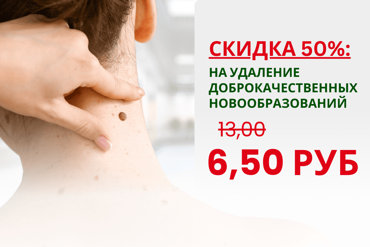 Скидка 50% на удаление новообразований в Медэлит